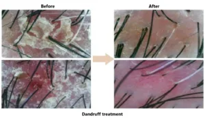 FAQ 2 dandruff treatment