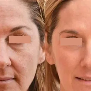 #1 Facial Houston Superjection